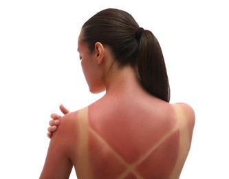 Photo of Woman with sunburned skin on white background, back view