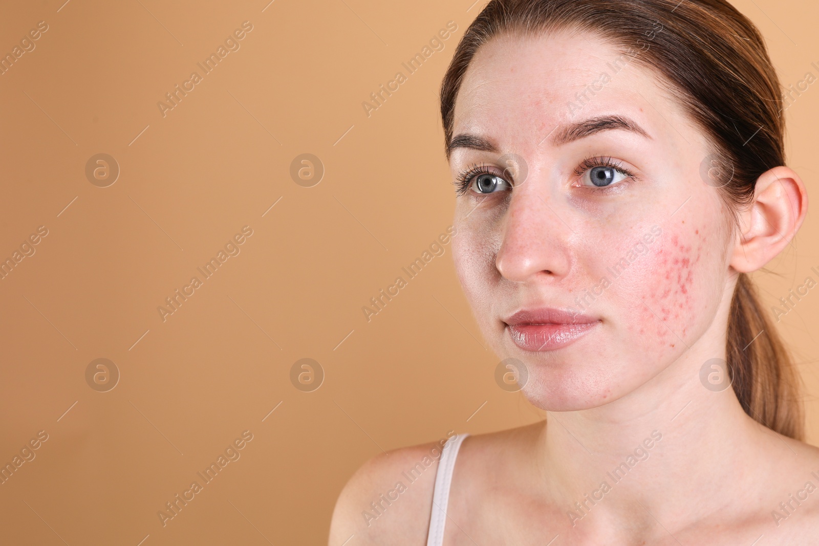 Photo of Young woman with acne problem on beige background. Space for text