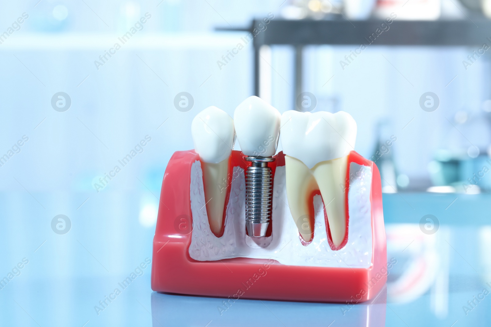Photo of Educational model of gum with dental implant between teeth indoors