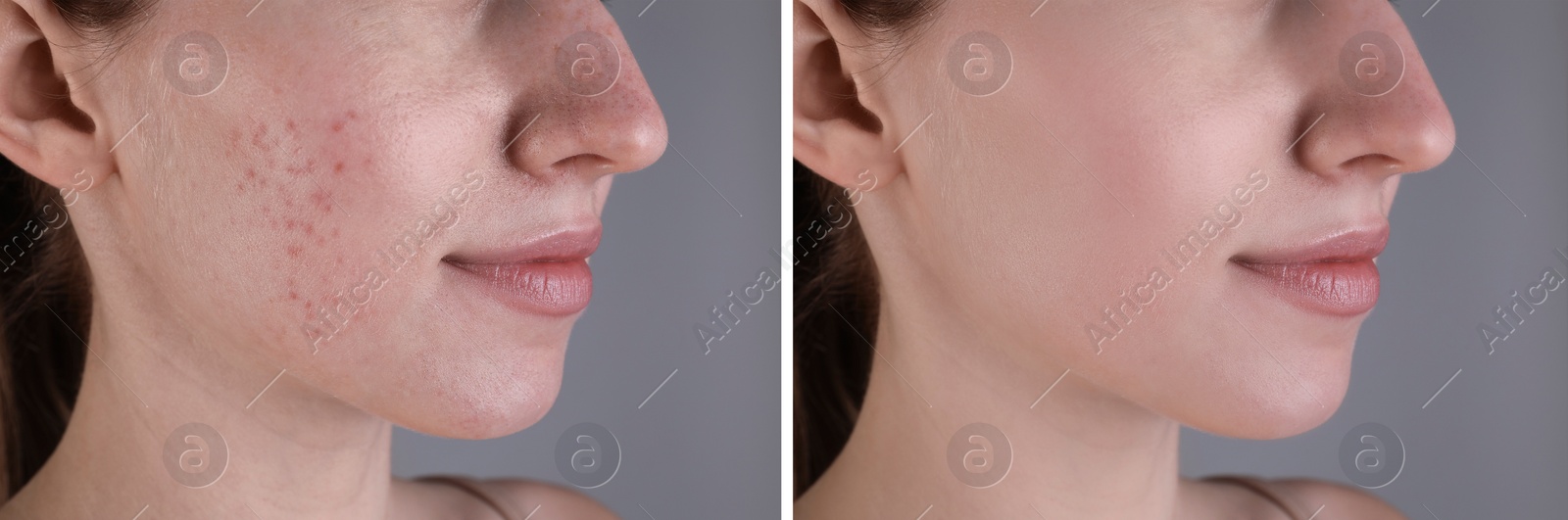 Image of Acne problem. Young woman before and after treatment on grey background, closeup. Collage of photos