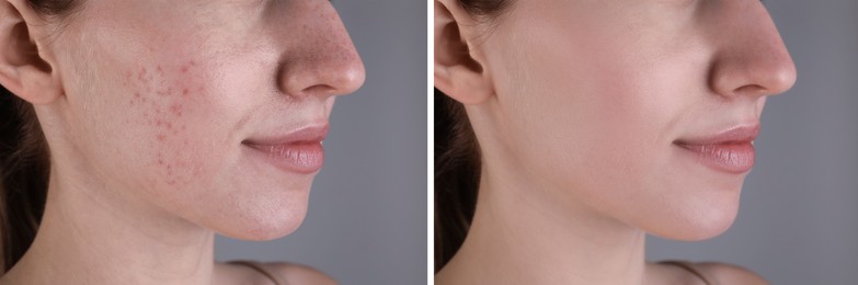 Acne problem. Young woman before and after treatment on grey background, closeup. Collage of photos