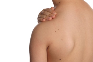 Photo of Closeup of boy's body with birthmarks on white background, back view
