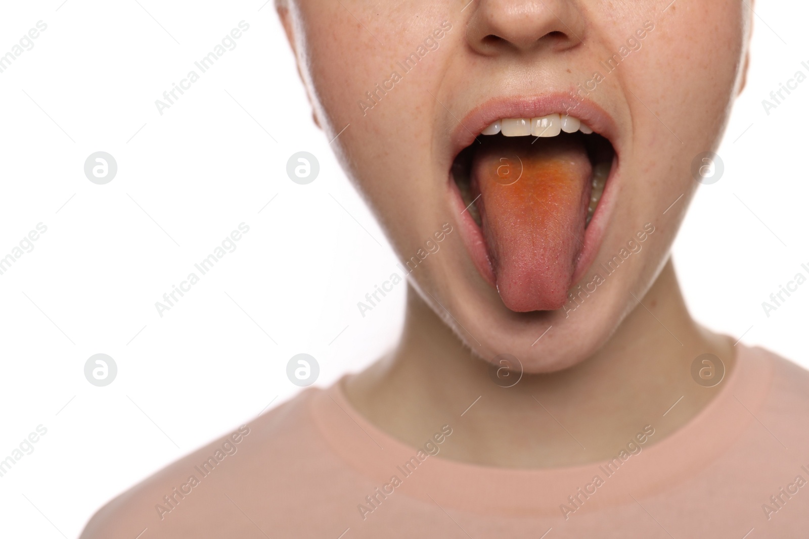 Photo of Gastrointestinal diseases. Woman showing her yellow tongue on white background, closeup