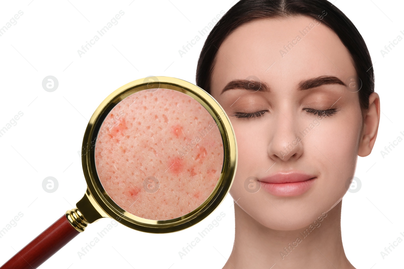 Image of Dermatology. Woman with skin problem on white background. View through magnifying glass on acne