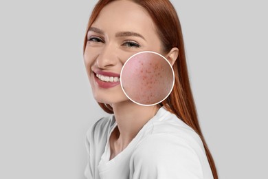 Woman with acne on her face on grey background. Zoomed area showing problem skin