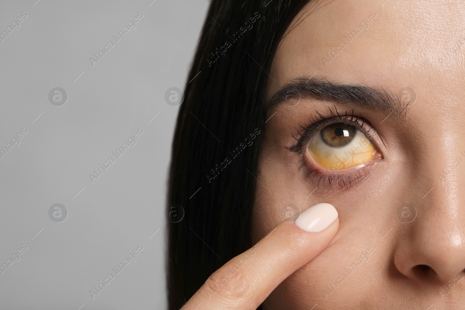 Photo of Woman checking her health condition on grey background, closeup. Yellow eyes as symptom of problems with liver