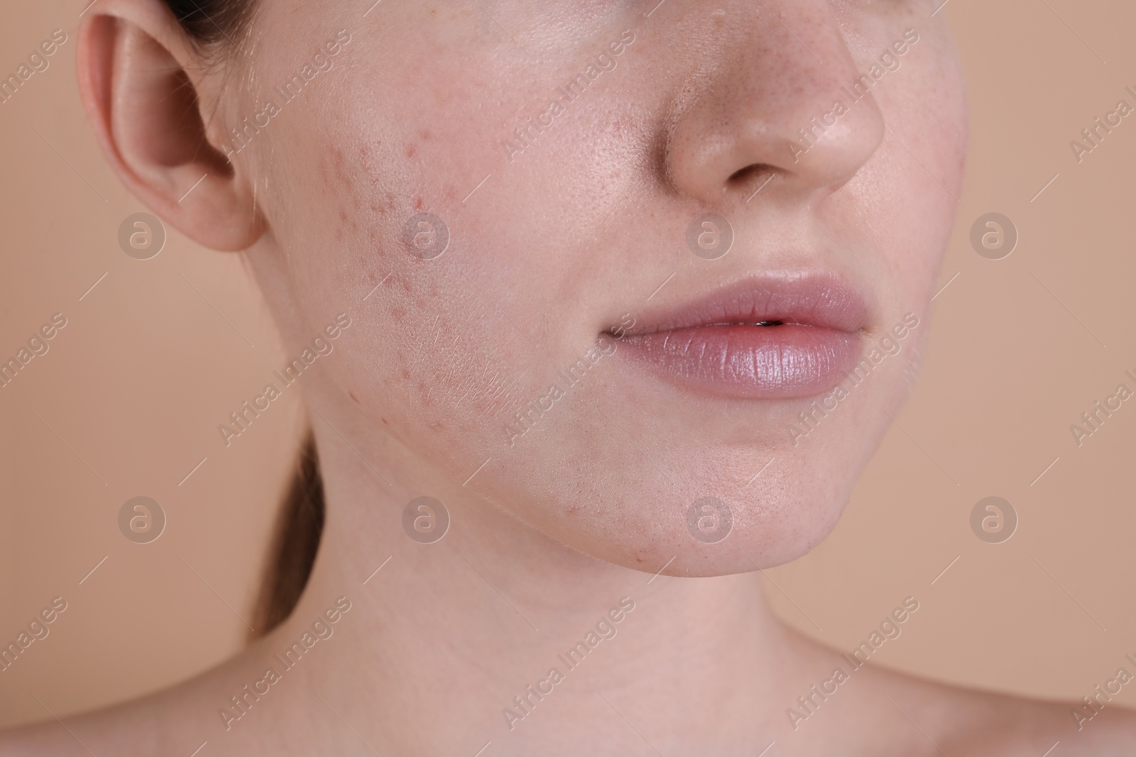 Photo of Young woman with acne problem on beige background, closeup