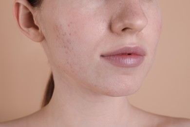 Photo of Young woman with acne problem on beige background, closeup