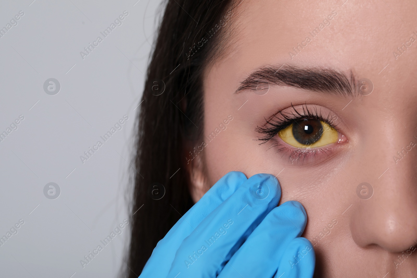 Photo of Doctor checking woman with yellow eyes on light background, closeup. Symptom of hepatitis