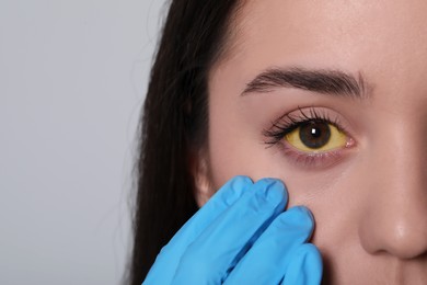 Doctor checking woman with yellow eyes on light background, closeup. Symptom of hepatitis