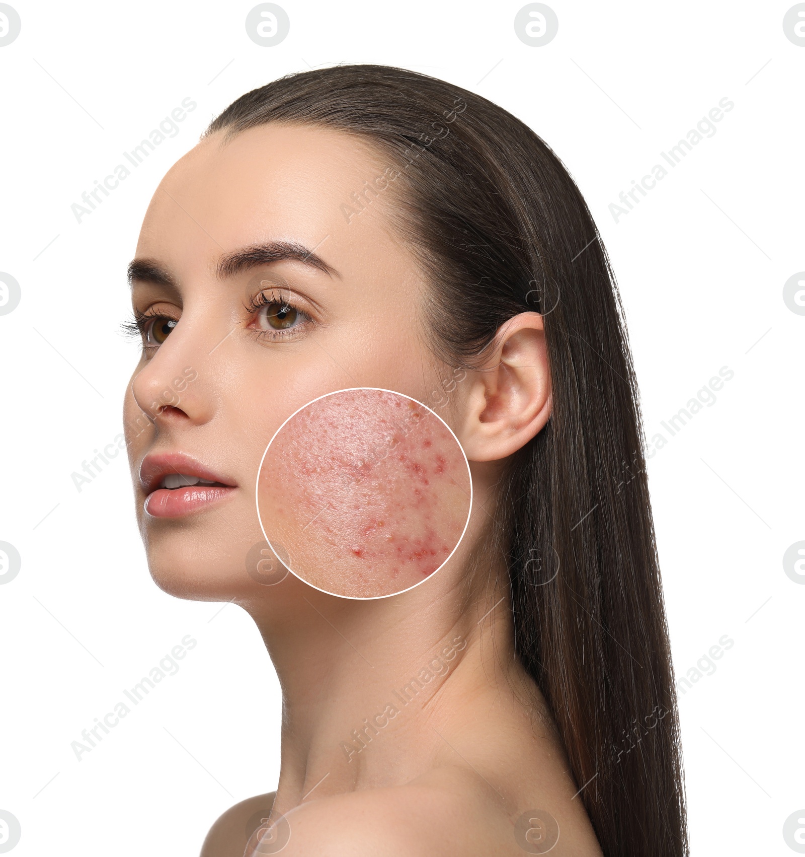 Image of Woman before and after cosmetology procedure on white background. Zoomed area showing problem skin