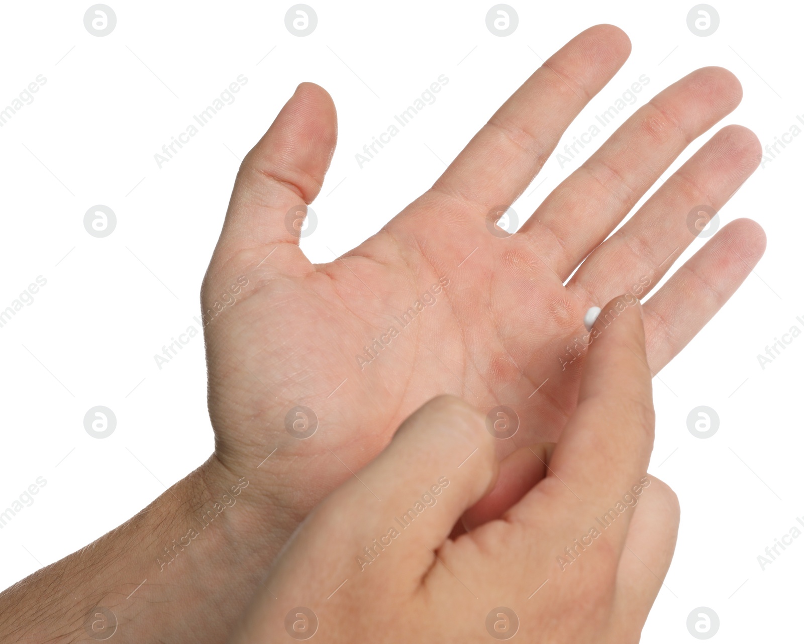 Photo of Man applying cream on hand for calluses treatment against white background, closeup