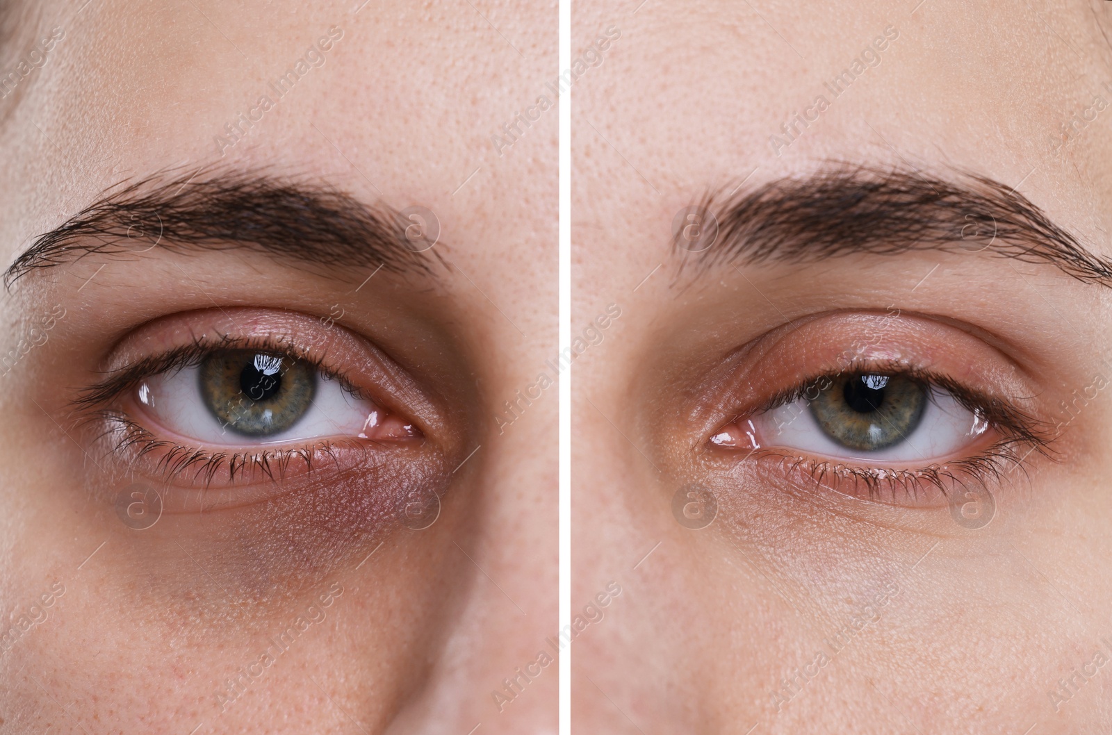 Image of Collage with photos of woman with dark circle under eye before and after treatment, closeup