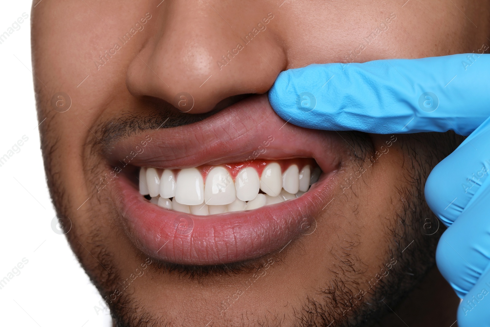 Image of Doctor examining man's inflamed gum on white background, closeup