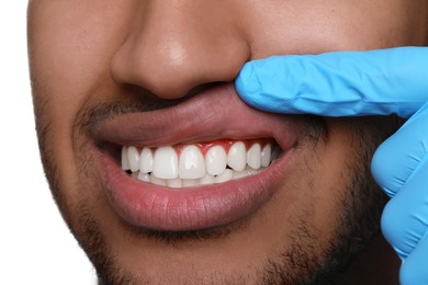 Image of Doctor examining man's inflamed gum on white background, closeup