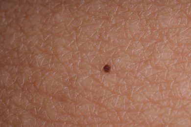 Photo of Texture of skin with birthmark as background, macro view