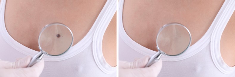 Mole removal. Collage with photos of patient's chest before and after procedure, closeup. Dermatologist looking at skin through magnifying glass