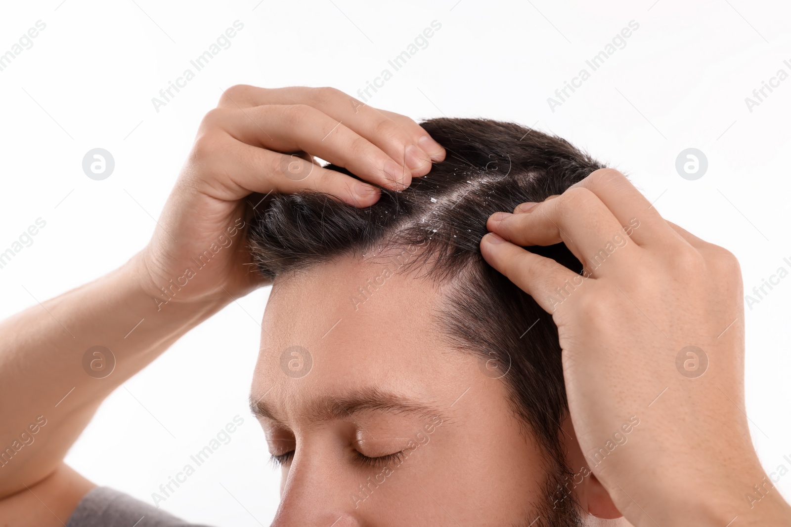 Photo of Man with dandruff in his dark hair on white background, closeup