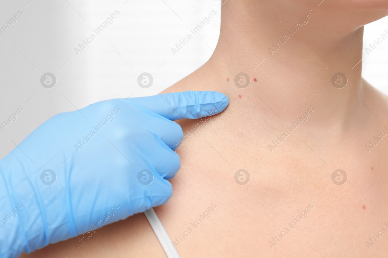 Photo of Dermatologist in rubber glove examining patient's birthmark on blurred background, closeup