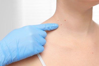 Dermatologist in rubber glove examining patient's birthmark on blurred background, closeup