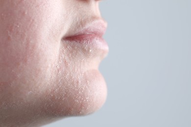 Photo of Woman with dry skin on face against light grey background, closeup. Space for text