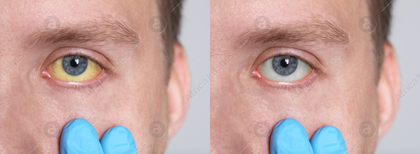 Image of Collage with photos of man before and after hepatitis treatment. Doctor checking patient, closeup. Banner design
