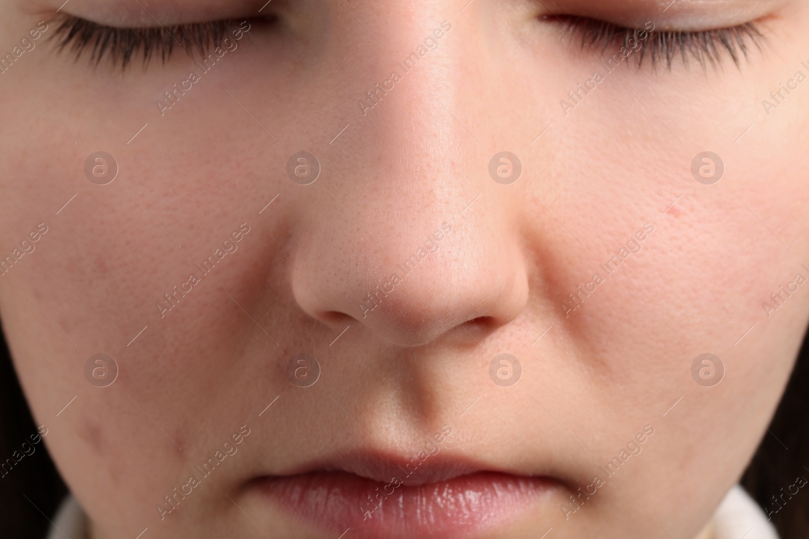 Photo of Young woman with acne problem, closeup view