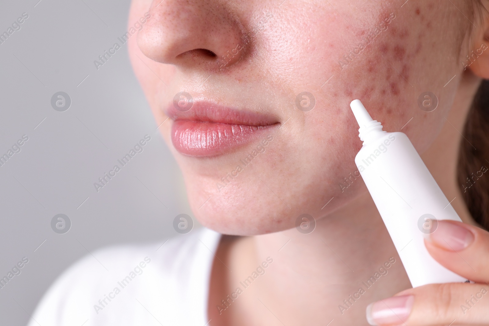 Photo of Woman with acne problem applying cream at home, closeup