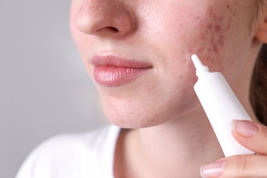 Photo of Woman with acne problem applying cream at home, closeup
