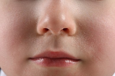 Little boy with dry skin on face, closeup