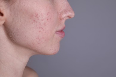 Photo of Young woman with acne problem on light grey background, closeup. Space for text