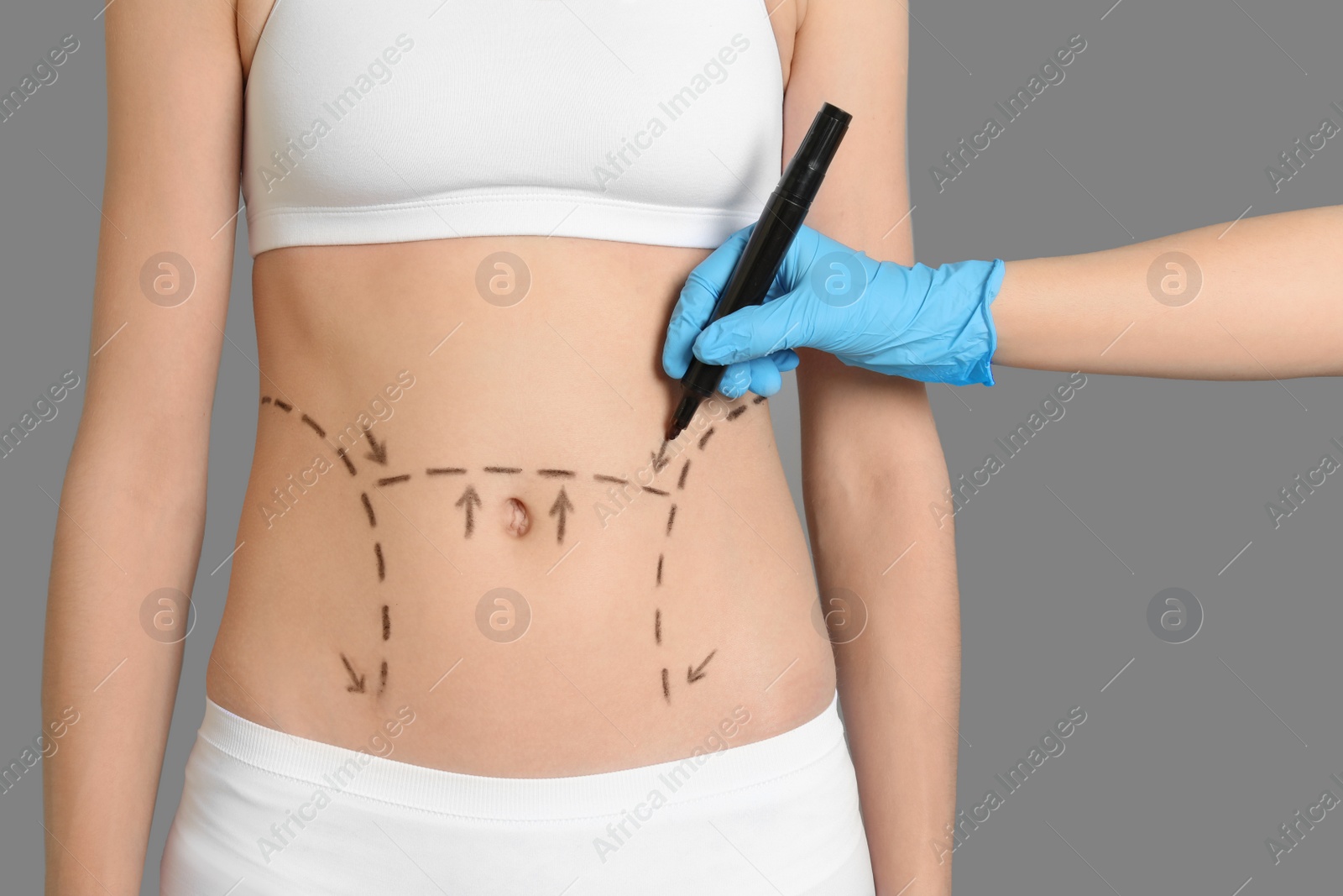 Photo of Doctor drawing marks on female belly for cosmetic surgery operation, closeup