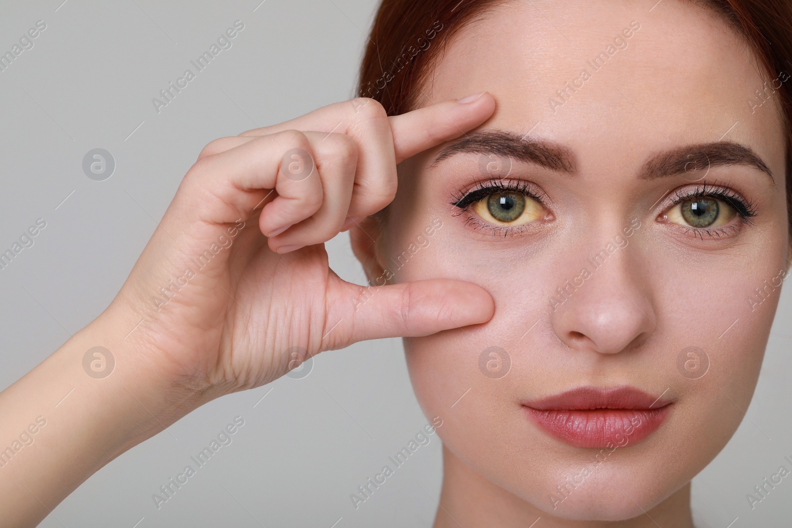 Photo of Woman with yellow eyes on light grey background. Symptom of hepatitis