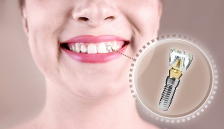 Image of Woman with beautiful smile after dental implant installation procedure on beige background, closeup