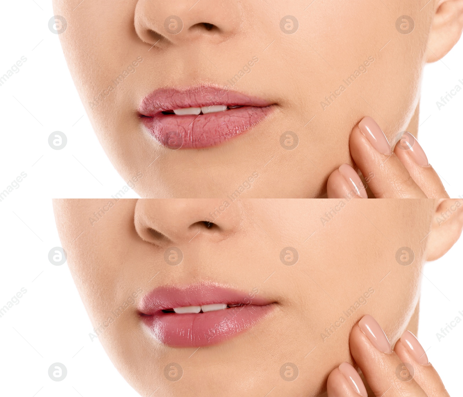 Image of Collage with photos of woman before and after using lip balm on white background, closeup