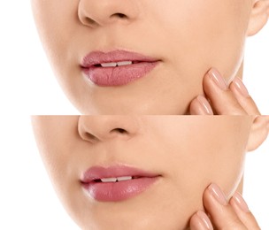 Image of Collage with photos of woman before and after using lip balm on white background, closeup