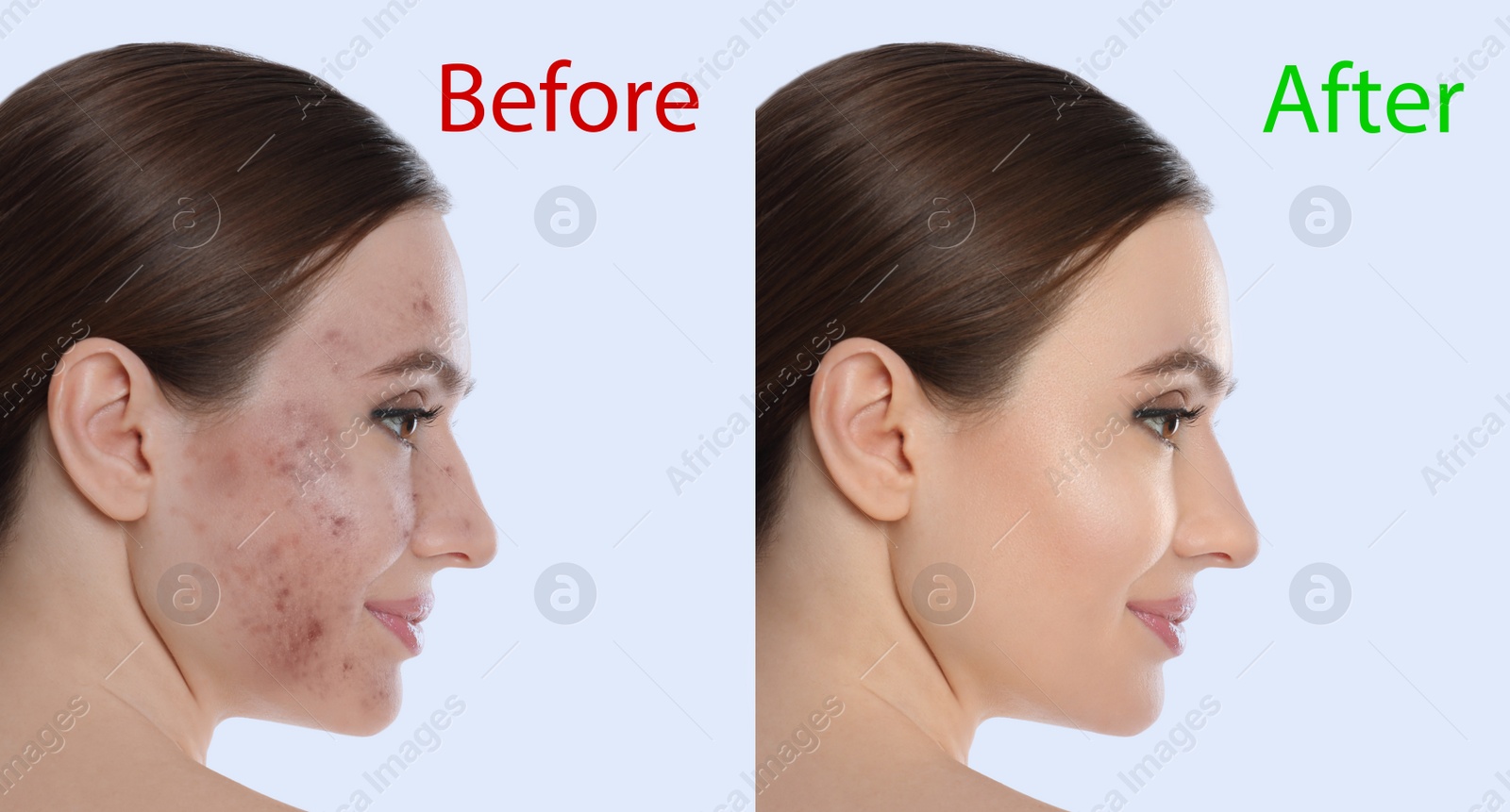 Image of Young woman before and after cosmetic procedure on light background