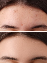 Image of Collage with photos of woman with acne problem before and after treatment, closeup