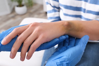 Photo of Doctor checking woman's wrist with bruise at hospital, closeup