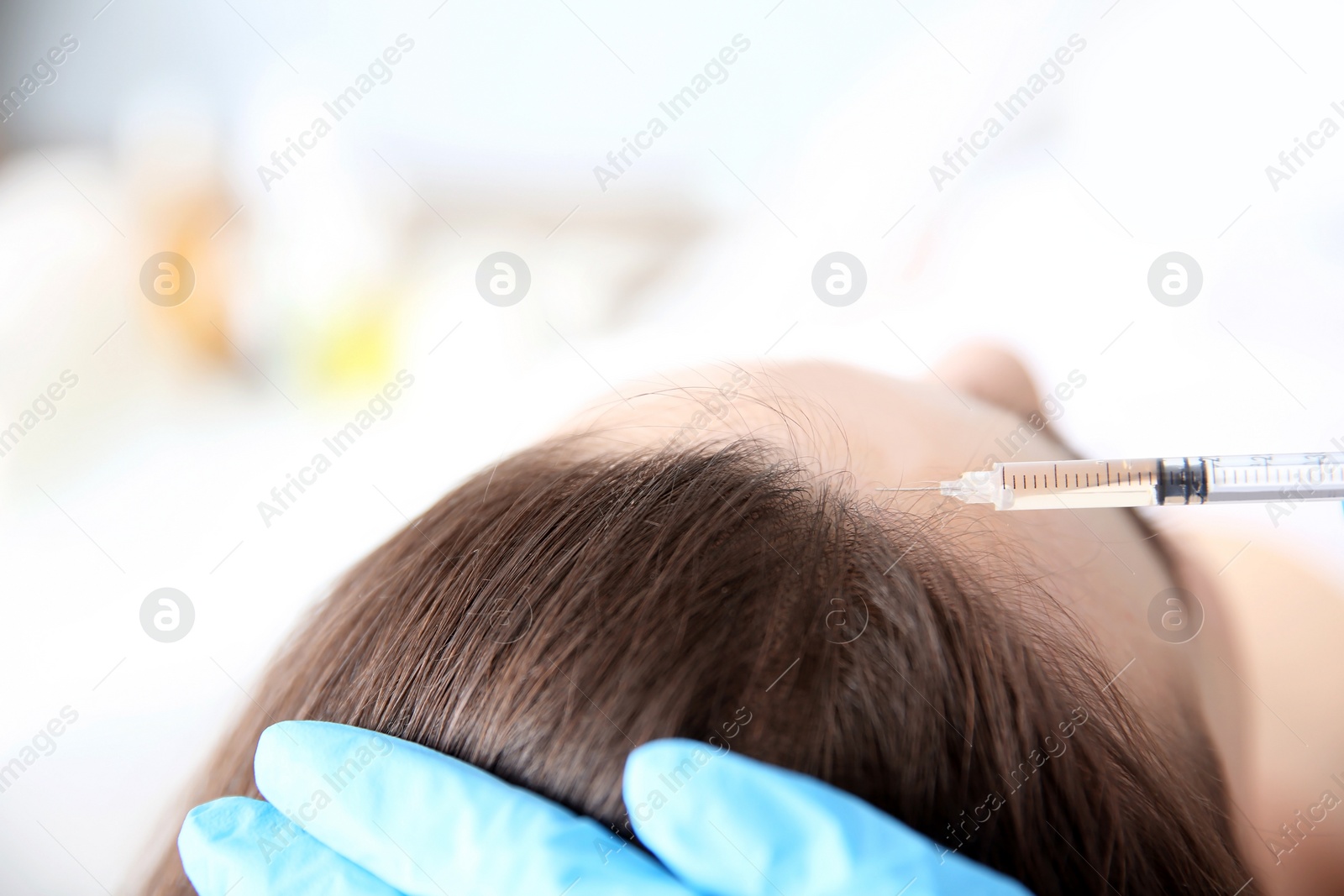 Photo of Young woman with hair loss problem receiving injection in clinic