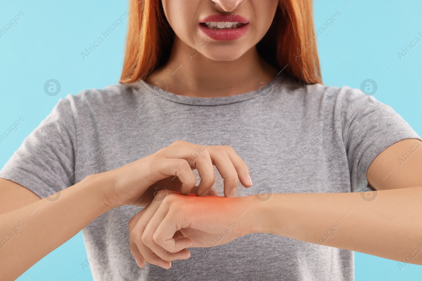 Photo of Suffering from allergy. Young woman scratching her arm on light blue background, closeup