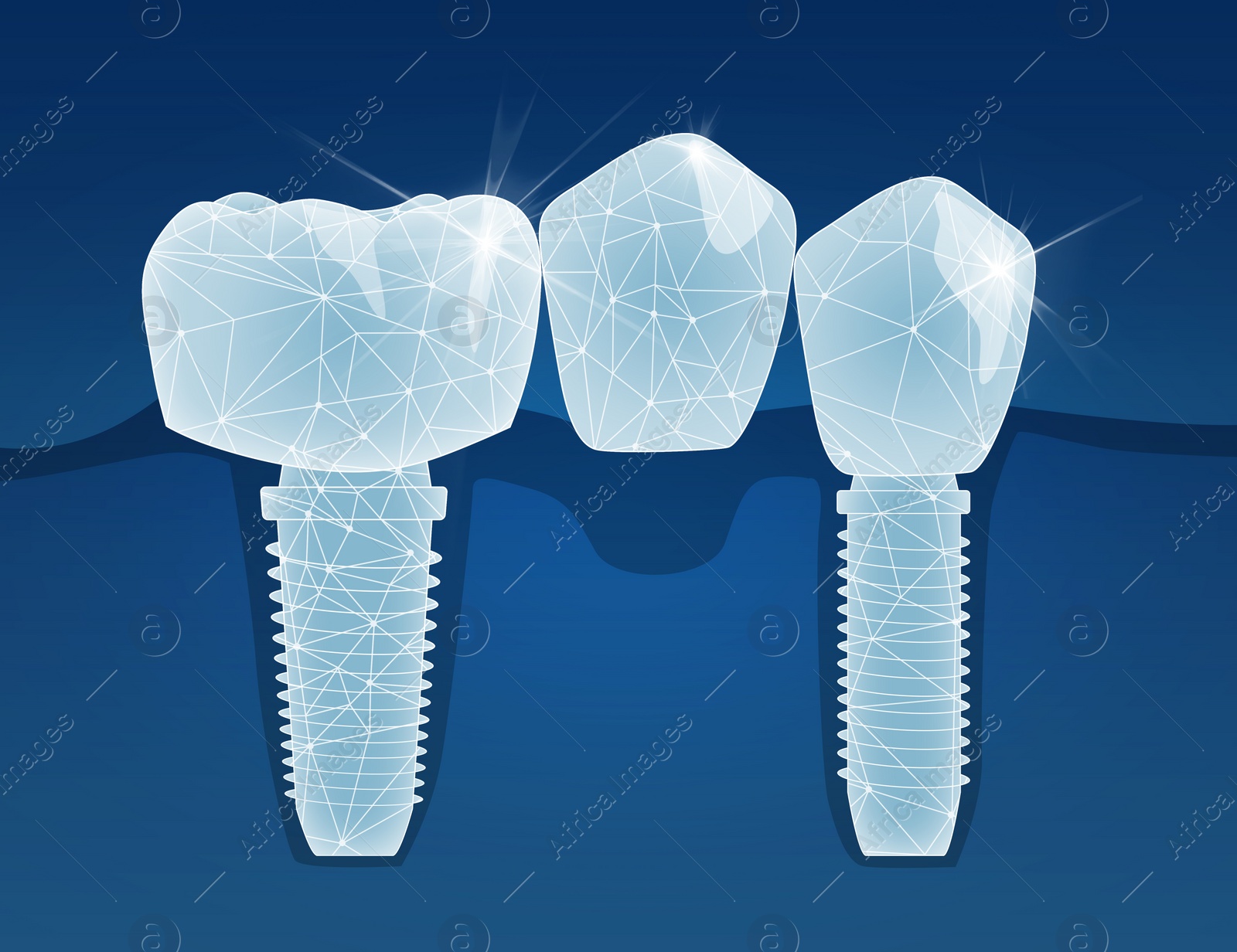 Illustration of  tooth and dental implants on blue background