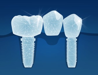 Illustration of  tooth and dental implants on blue background