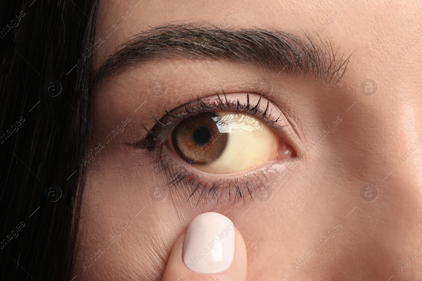 Photo of Woman checking her health condition, closeup. Yellow eyes as symptom of problems with liver