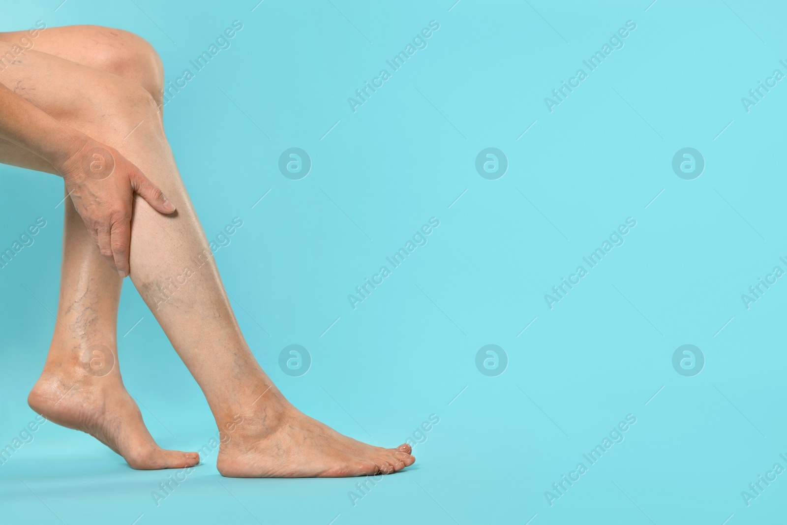 Photo of Closeup view of woman suffering from varicose veins on light blue background. Space for text