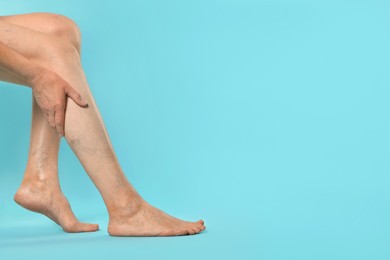 Photo of Closeup view of woman suffering from varicose veins on light blue background. Space for text