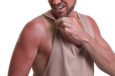 Man with sunburned skin on white background, closeup