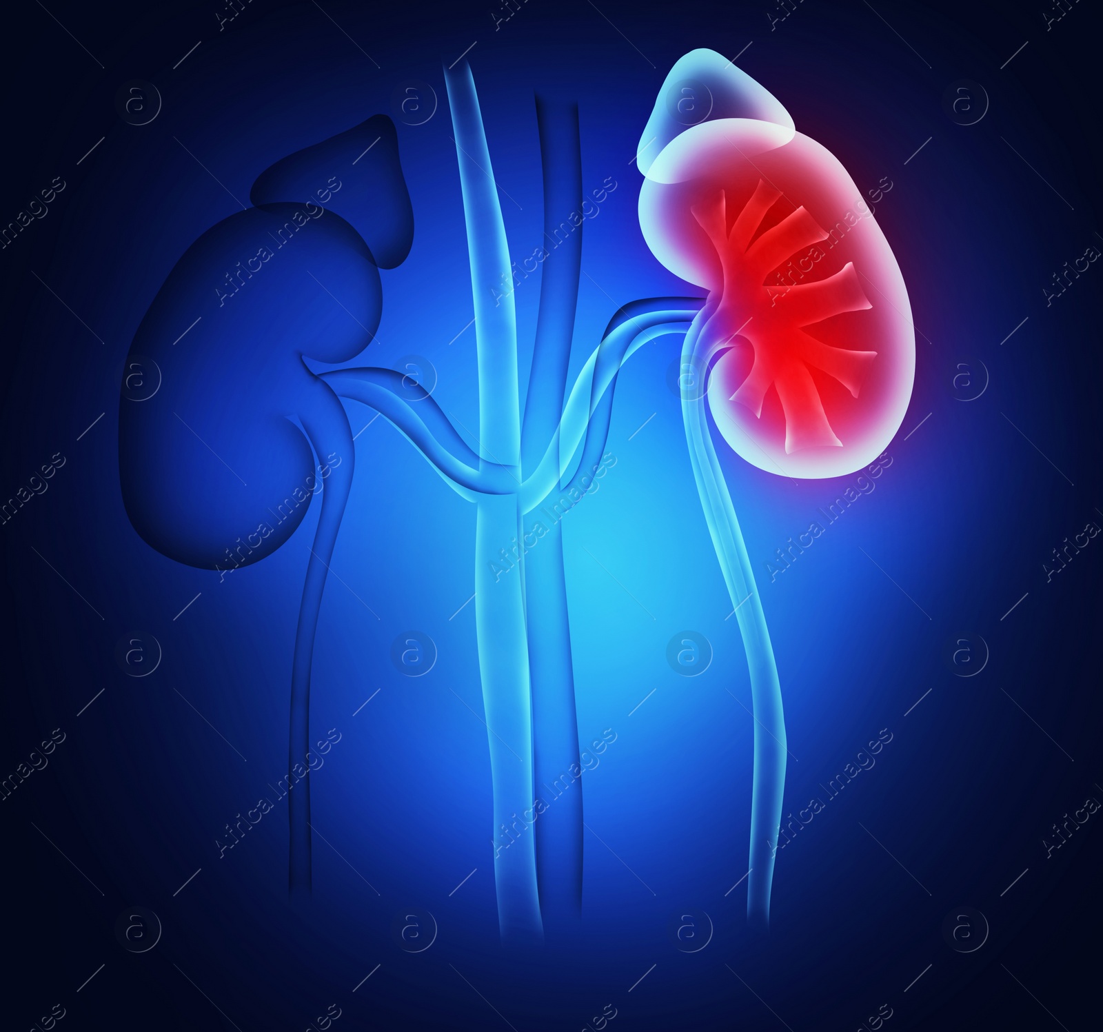 Illustration of  healthy and inflamed kidneys on blue background