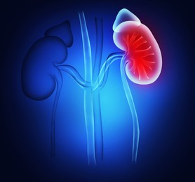 Illustration of  healthy and inflamed kidneys on blue background