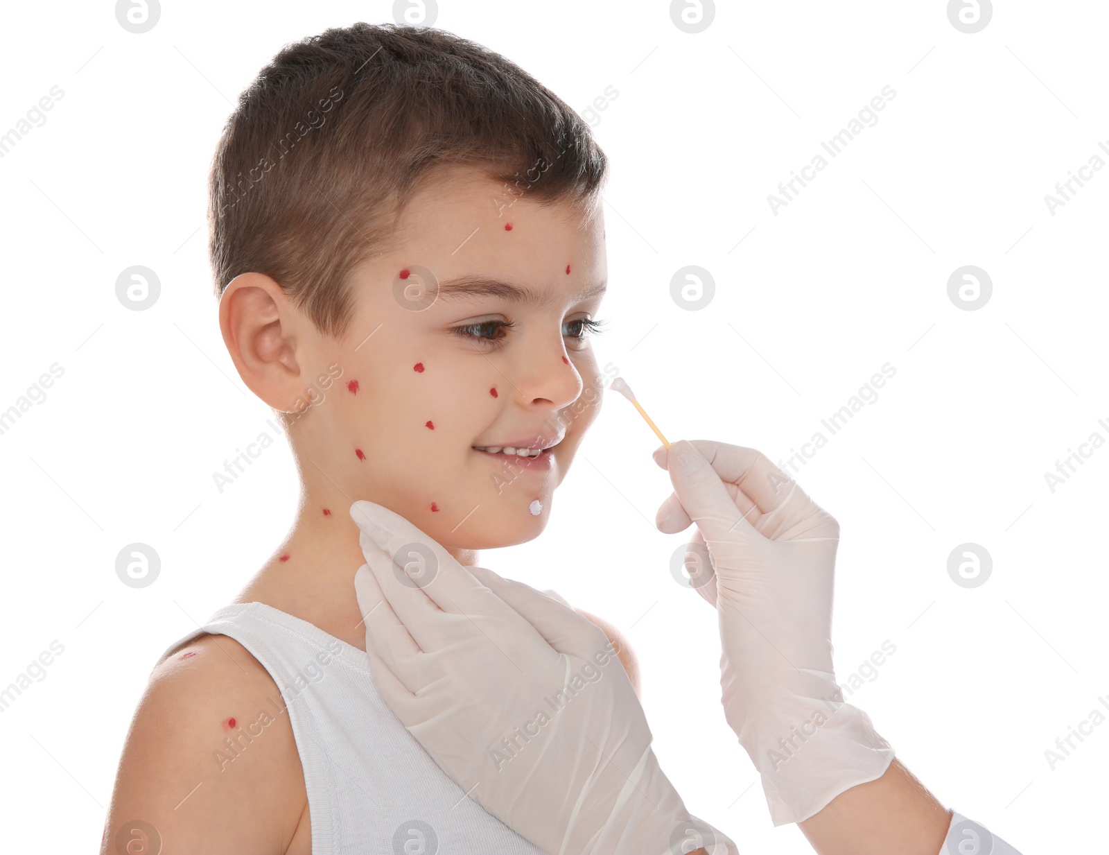 Photo of Doctor applying cream onto skin of little boy with chickenpox on white background. Varicella zoster virus